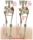 Hip Bursitis and Other Issues - ATX Orthopedics