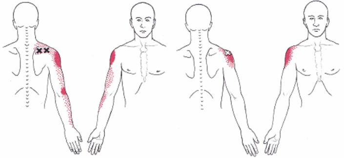 SHOULDER PAIN - ATX Orthopedics