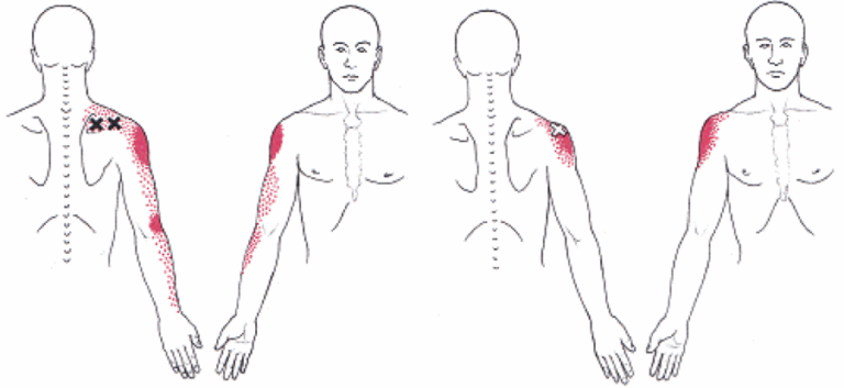 shoulder pain radiating down arm