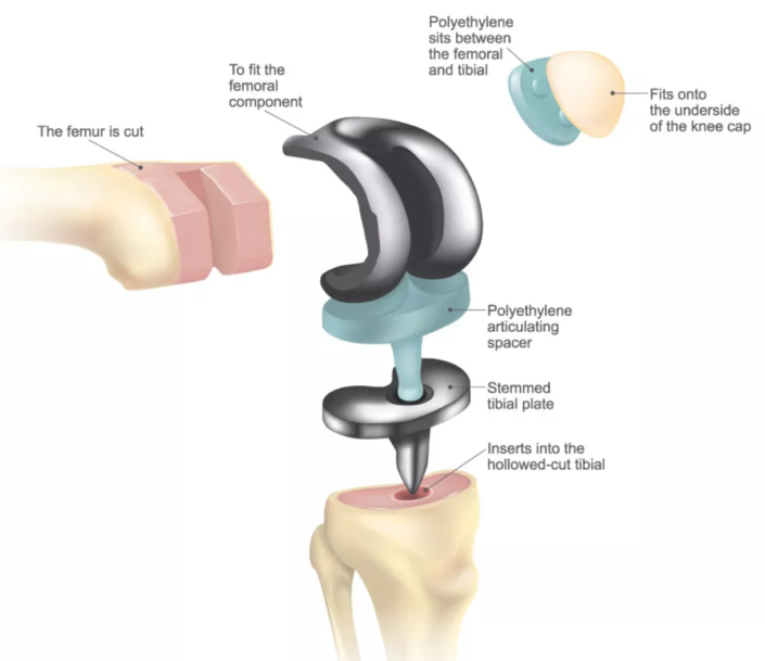 Knee Replacement Surgeon & Specialist in Austin, TX - ATX Orthopedics