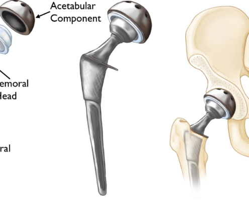 hip replacement graphic