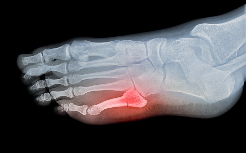 Ankle Fractures Treatment  Foot Doctor Southlake, Keller, Flower Mound,  North Richland Hills, Argyle and Denton, TX